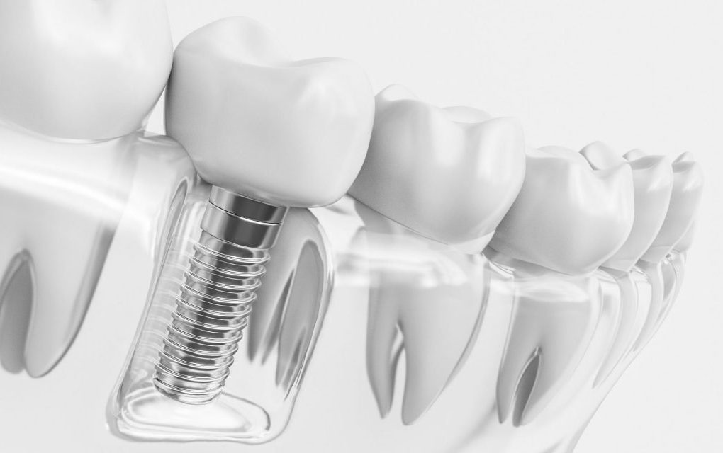 Transforming Dental Health with Implant Durability Innovations