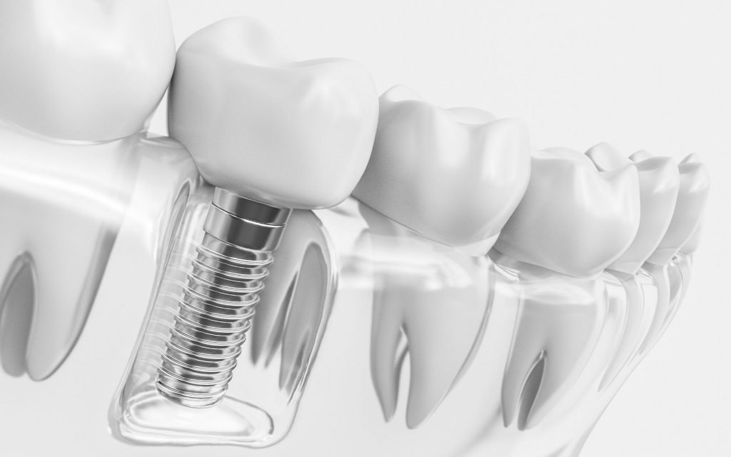 Transforming Dental Health with Implant Durability Innovations