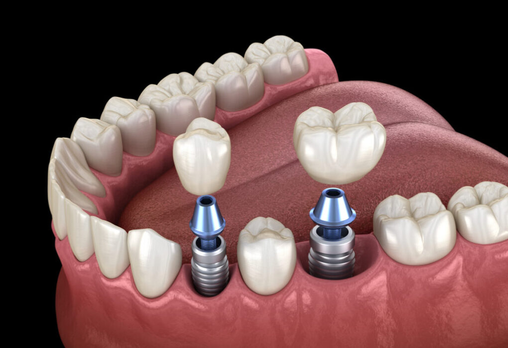 Understanding How Dental Implants Integrate with Your Jawbone Structure