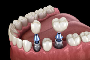Understanding How Dental Implants Integrate with Your Jawbone Structure