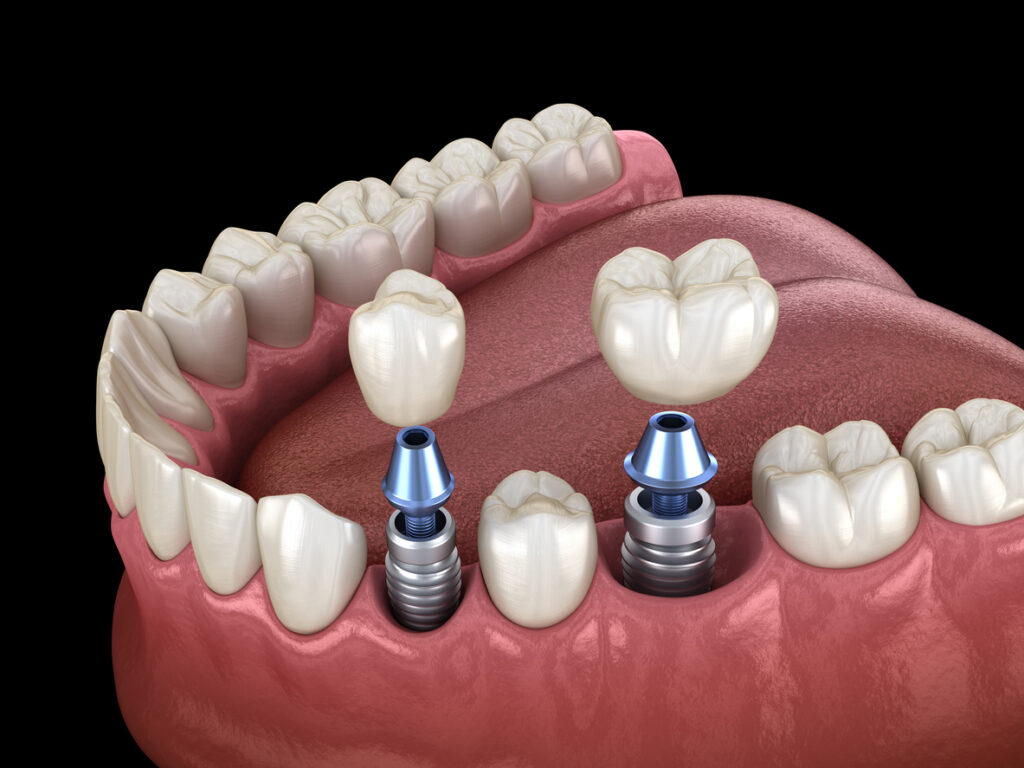 Understanding How Dental Implants Integrate with Your Jawbone Structure